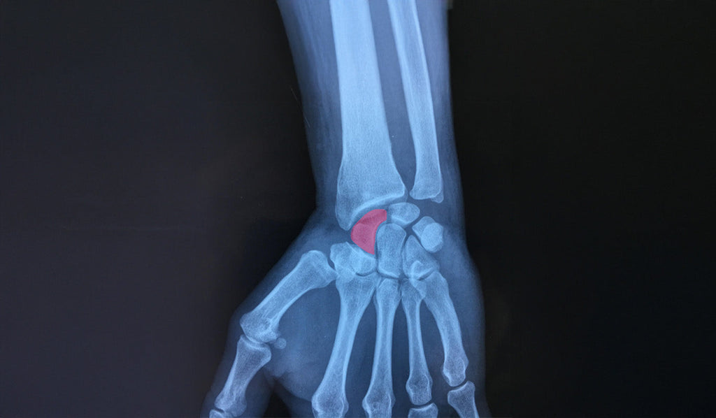 Fracture