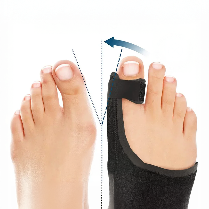 Attelle hallux valgus avec barres réglables